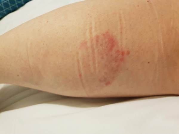 Could anyone diagnose this? Funny mark on leg...