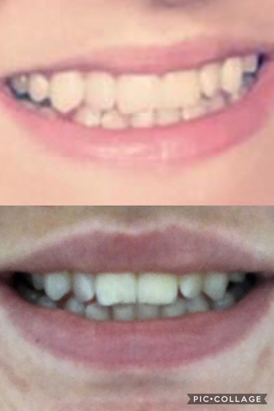 Should I get lip fillers? Pic