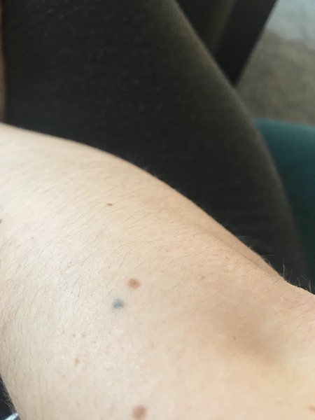 Blueish spot under DS skin (pic)