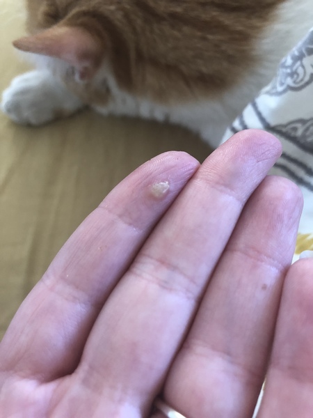 AIBU to insist on a gp apt for “just a wart” (disgusting pic included)