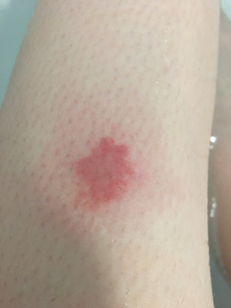 Horsefly bite? I want to scratch my leg off!