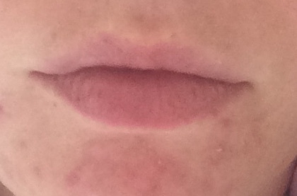 Should I get lip fillers? Pic