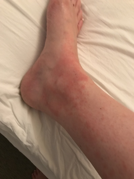 Itchy feet and palms
