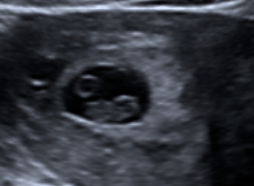 What can I expect to see on a scan at seven weeks?