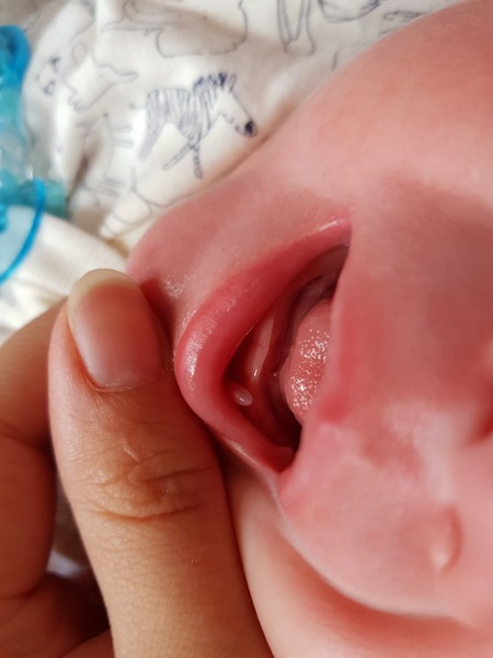 Please please help something strange in my sons mouth!