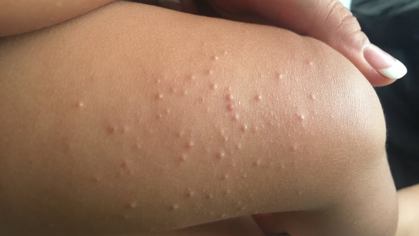Any idea what these raised bumps could be?