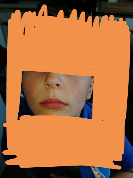 Talk to me about childhood lupus