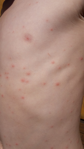 Let's play - what on earth caused this rash.