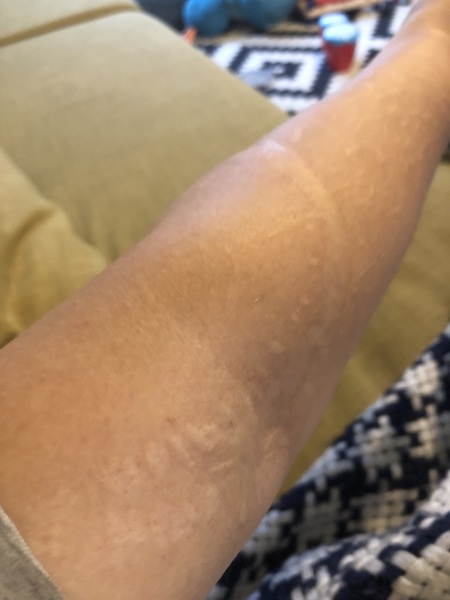 AIBU to ask about your weird injuries?