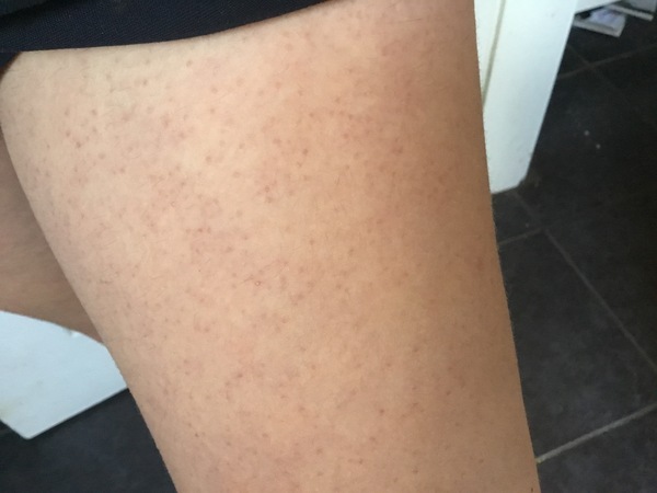 Teenage DD has small red spots on her legs