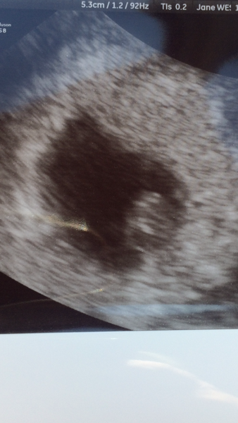 Empty Sac - anyone had this with successful outcome?