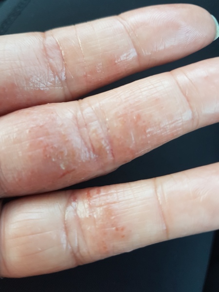 Eczema - managing it when pregnant