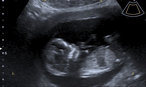 13 weeks nub theory