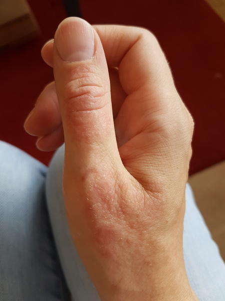 WIBU to cut my own thumb off?