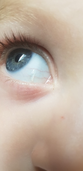 Blob on eye