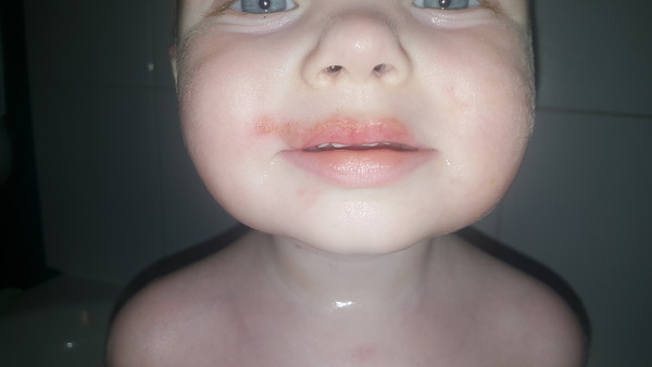 Rash - should I be worried?