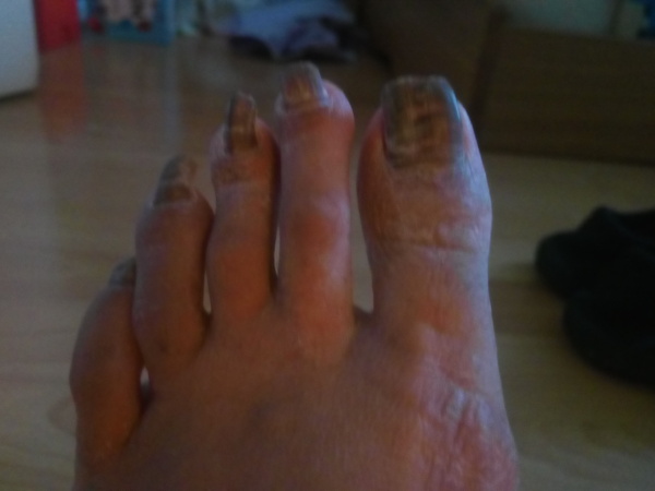 To want toenail fungus to go forever