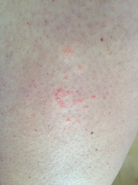 Prickly heat or bites?