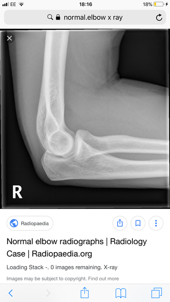 ds(12) broken elbow - second opinions