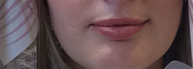 Sooo, who’s tried lip fillers?!