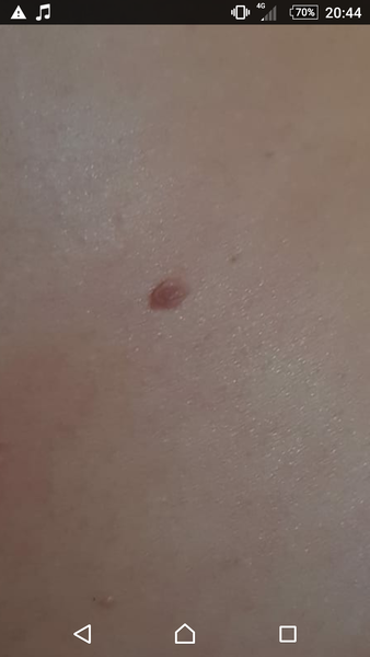 How do you know if a mole is dangerous?