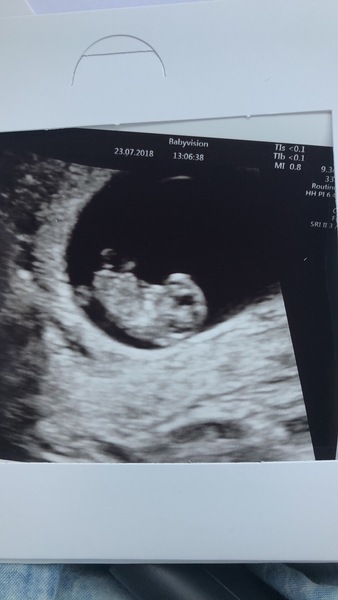 9 weeks and scared for scan next week incase of another miscarriage - need positive examples!