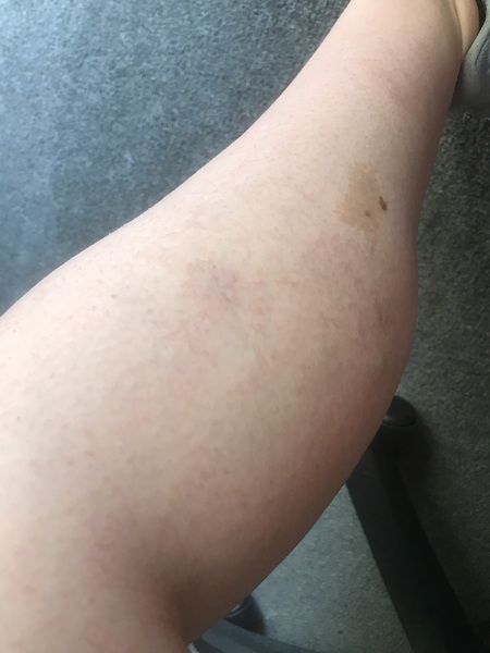 Varicose veins