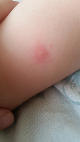 Acne like spots