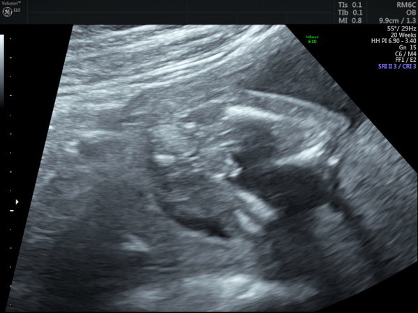 Gender scan being wrong