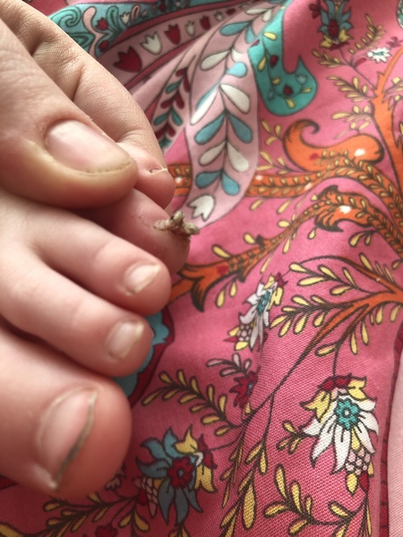 AIBU to insist on a gp apt for “just a wart” (disgusting pic included)