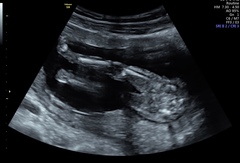 Early gender scan-Is it really a girl?