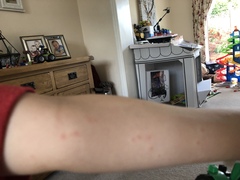 Have any of you seen this type of rash before?