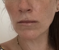 Sooo, who’s tried lip fillers?!