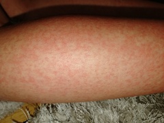 Talk to me about childhood lupus