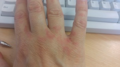 Sore painful hands