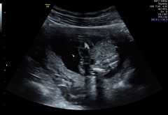 Early gender scan-Is it really a girl?