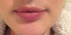 Sooo, who’s tried lip fillers?!