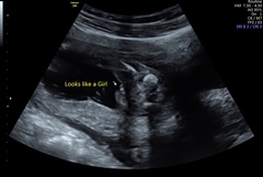 Early gender scan-Is it really a girl?