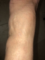 Tiny flat warts on hands and feet