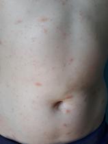Another DC with a rash!