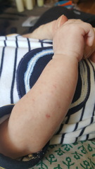 Post for traffic- baby's rash
