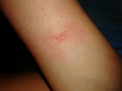 Are these horsefly bites?