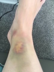 Is this just a bad bruise?