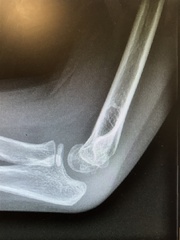 ds(12) broken elbow - second opinions