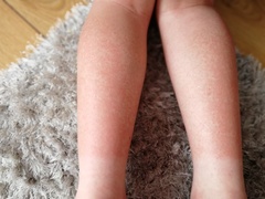 Talk to me about childhood lupus