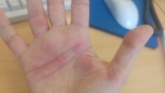Sore painful hands