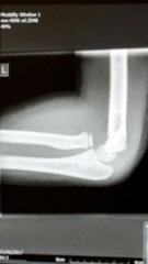 ds(12) broken elbow - second opinions