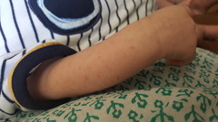 Post for traffic- baby's rash