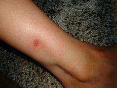 Are these horsefly bites?