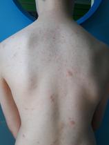 Another DC with a rash!